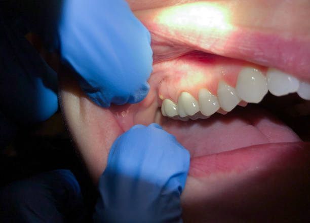 Tooth Infection Emergency Dentist in NY